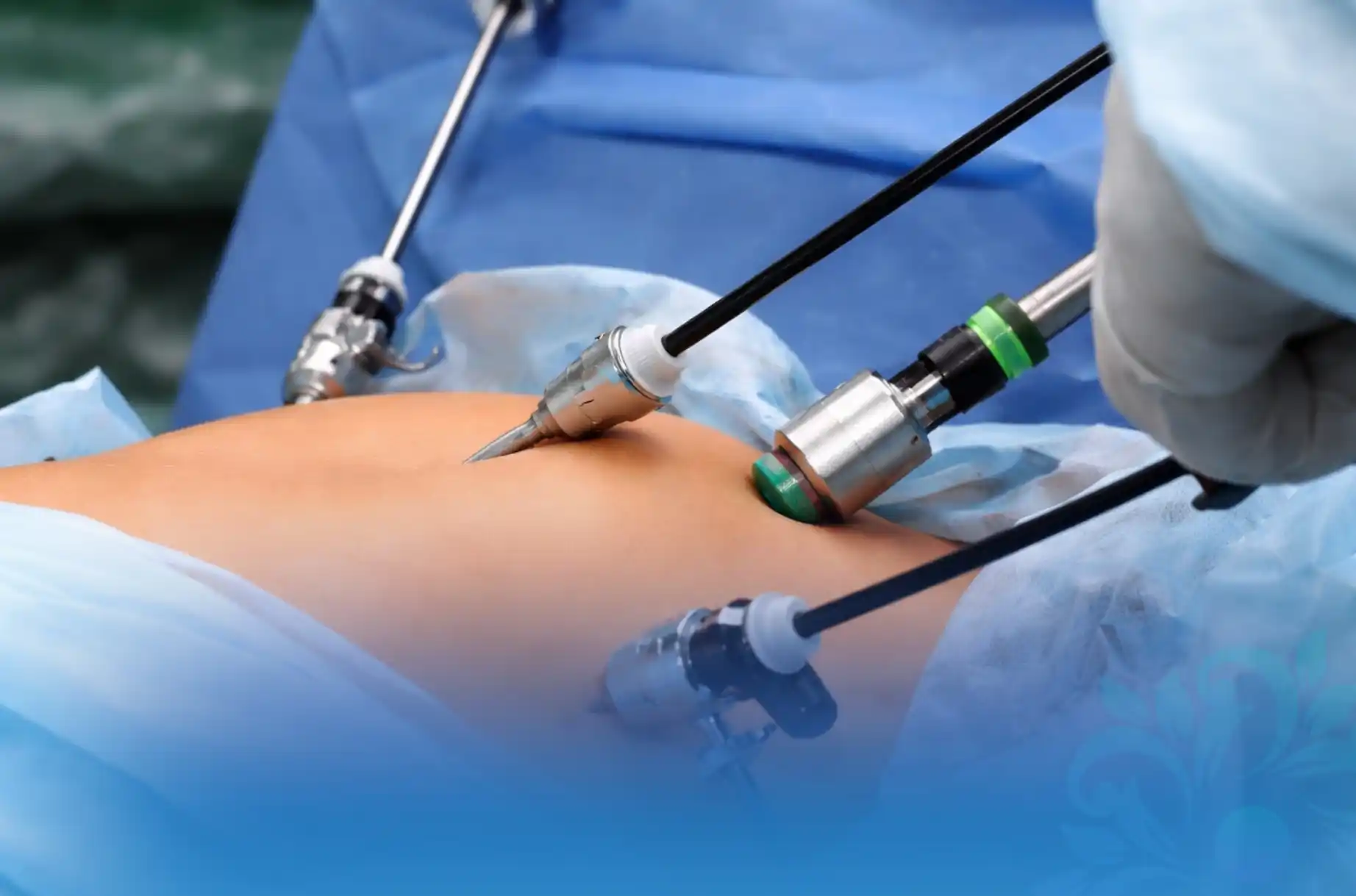 Laparoscopic surgery